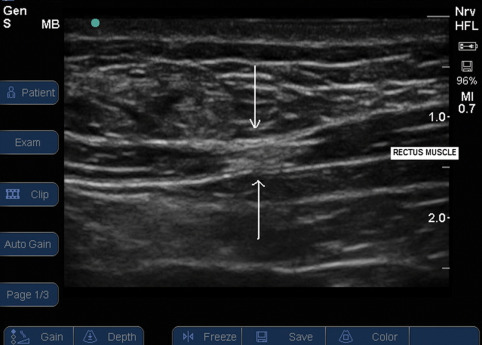 ultrasound image of a Trigger point